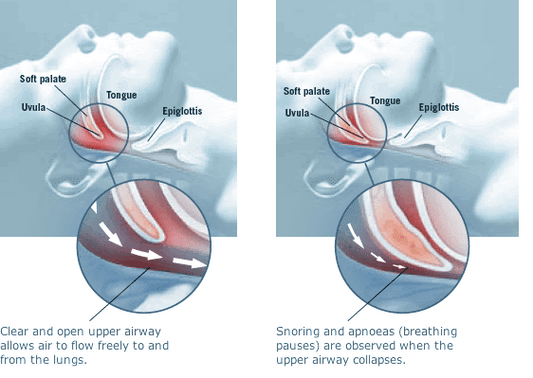 Understanding Sleep Apnea: Causes, Symptoms, and Treatment